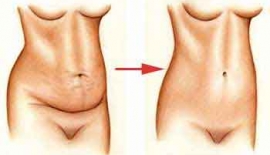 Abdominoplasti Karın Germe Ameliyatı