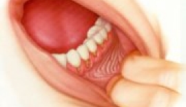 Ağız İçi Tümörleri Nelerdir?