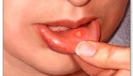 Ağız Yaraları