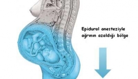 Ağrısız Doğum Epidural Anestezi