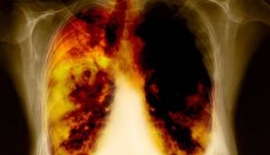 Akciğer Kanseri Nedir?