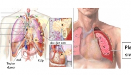 Akciğer Kanseri Tedavisi