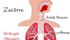Akciğer Lobu Zatürreesi Nedir?