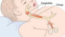 Akut Bronşit Şikayetleri