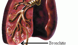 Akut Bronşit