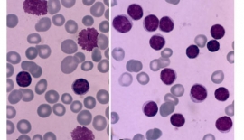 Akut Lenfositik Lösemi