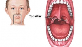 Akut Tonsillit