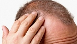 Alopesi Nedir?