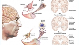 Alzheimer Hastalığı Nedir?