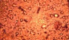 Amipli Dizanteri Teşhisi