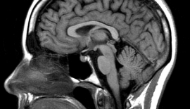 Amorotik Kalıtsal Akıl Geriliği Nedir?