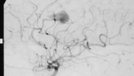 Anevrizma Kliplenmesi