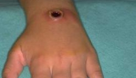 Antraks Nasıl Gelişir?