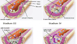 Arterioskleroz Damar Sertliği