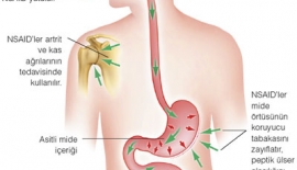 Artritin Tedavisinde Kortizonun Rolü Nedir?