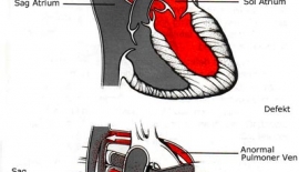 Atriyal Septal Defekt