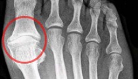 Ayak Başparmağında Çıkıntı