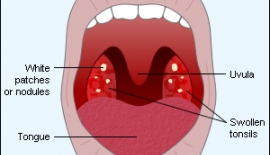 Bademcik İltihabı Tonsillittonsillektomi