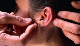 Bağımlılık Tedavisinde Akupunktur