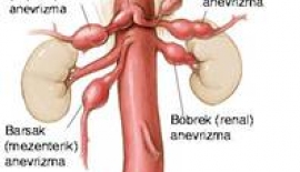 Barsak Damar Tıkanıklığı