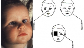 Bebeklerde Şaşılık Tedavisi