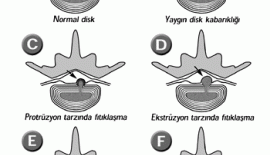 Bel Fıtığı Belirtileri