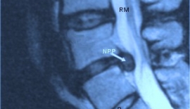 Bel Fıtığı Nasıl Tedavi Edilir?