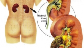 Böbrek Ağrısı