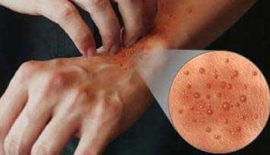 Böcek Allerjisi Nedir?