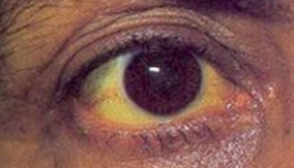 Bulaşıcı Sarılık Nerelerde Bulunur?