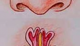 Burun Tıkanıklığı Nedir?