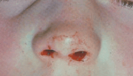 Burunda Kırık Tedavisi