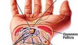 Carpal Tünel Sendromu