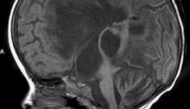 Chiari Malformasyonu