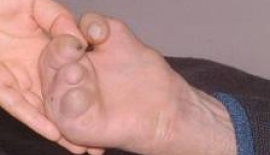 Cüzzam Bulaşıcı Mıdır?