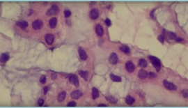 Medüller Tiroid Kanseri