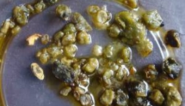 Safra Taşının Tanısı