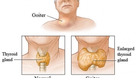 Tiroidit Guatr Nodülü