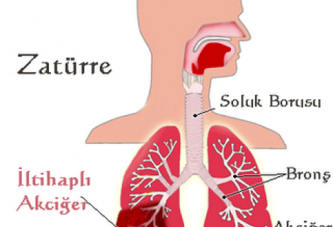 Akciğer Lobu Zatürreesi Nedir?
