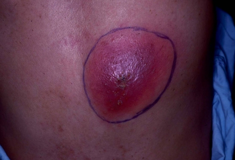 Apseler Ve İltihaplar