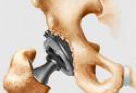 Artoplasti
