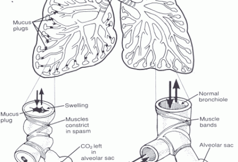 Astımın Belirtileri Nelerdir?