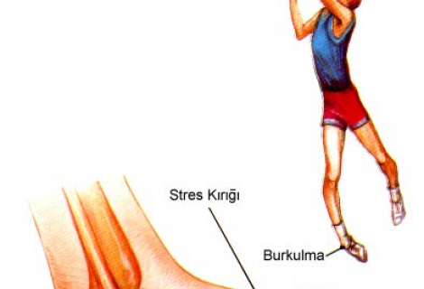 Ayak Bileği Burkulması