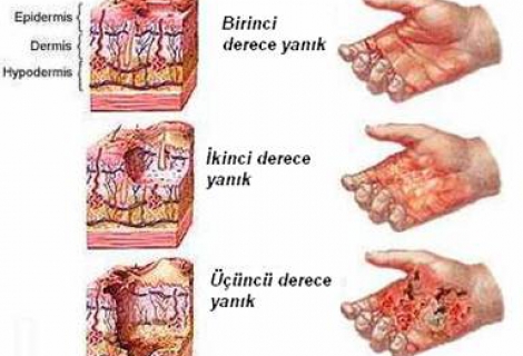 Bebeklerde Yanık