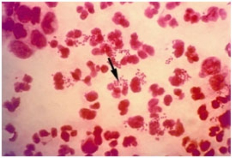 Bel Soğukluğu Tedavisi