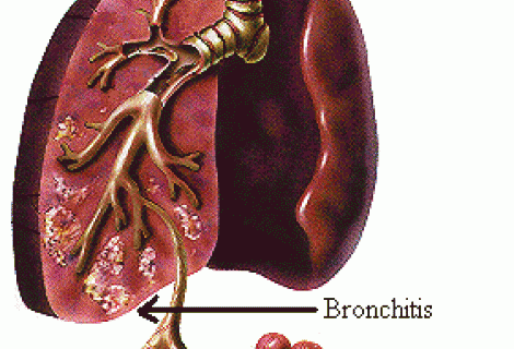 Bronşektazi Bronş Genişlemesi