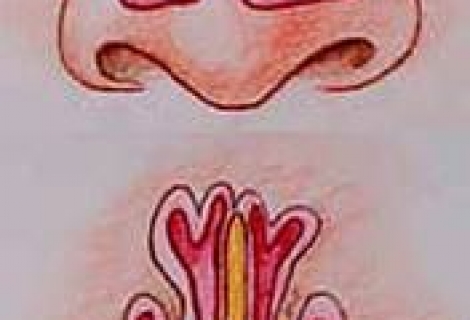 Burun Tıkanıklığı Nedir?