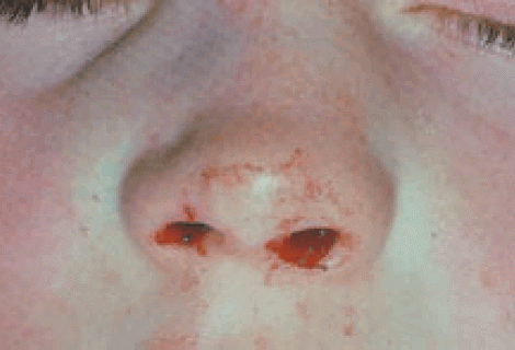 Burunda Kırık Tedavisi