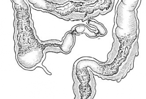 Crohn Hastalığı Regional Enterit