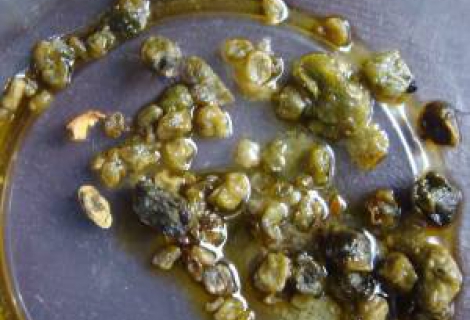 Safra Taşının Tanısı